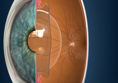 Implantable Collamer Lens (ICL)